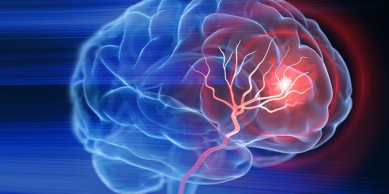 brain stroke